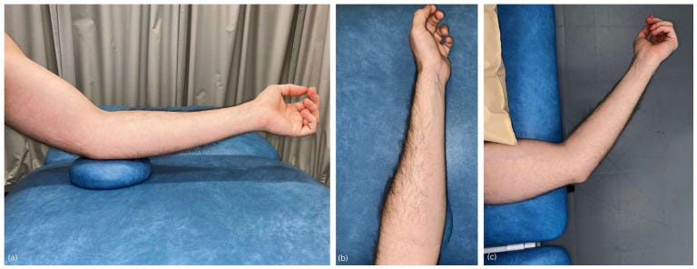 Tendon distal biceps 2 2 Tempo Formacion Ecografia.jpg